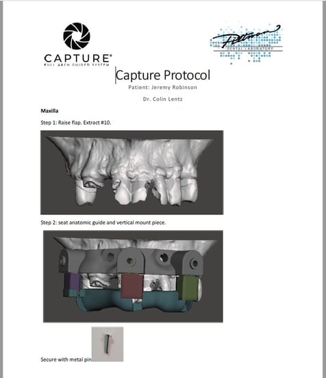 Capture®: Pittman Dental Lab's Guided Full-Arch Solution