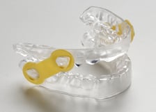 EMA Splint2