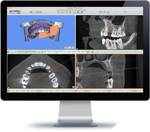 Implant-Planning-System