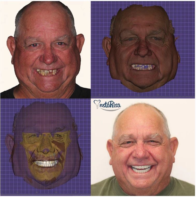 InstaRisa before and after