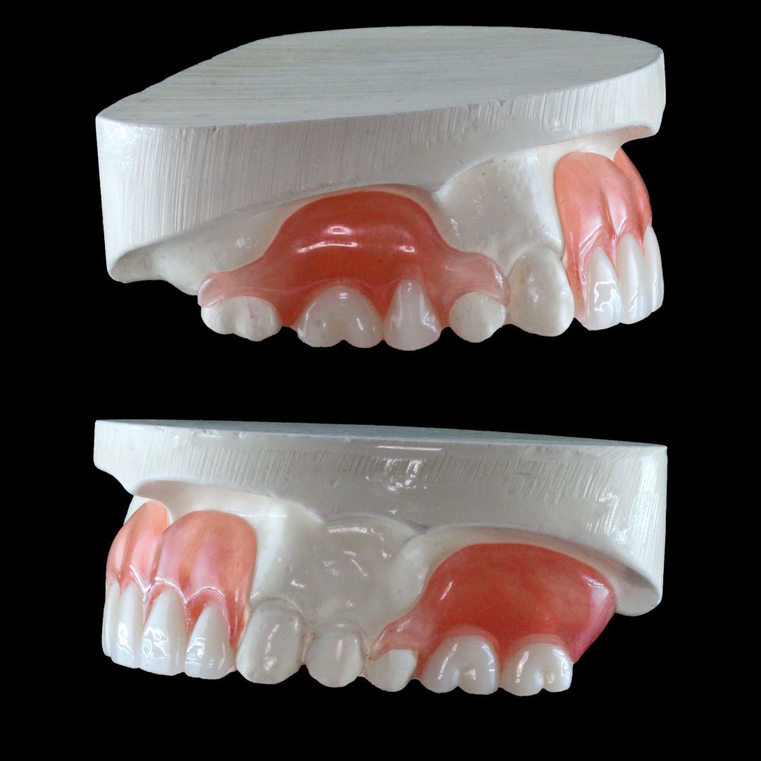 Denture and Partials Pittman Dental Laboratory