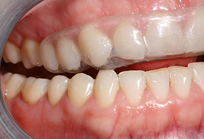 Maxillary Anterior Passive Appliance