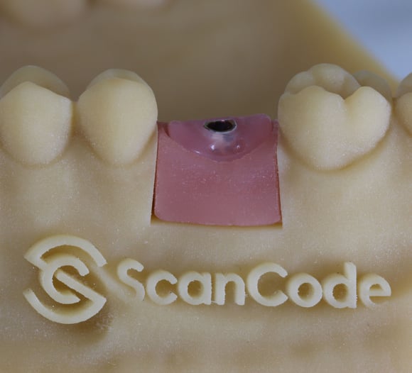 Encode Implant Code Map ScanCode: A Game Changer in Dental Implant Healing